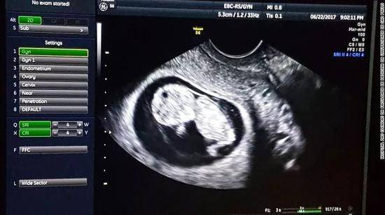 超声波图显示胎儿在移植子宫里正常发育。图自CNN