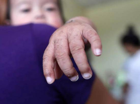 2月7日，菲律宾马尼拉，感染麻疹的患儿在医院接受治疗（图片来源：东方IC）