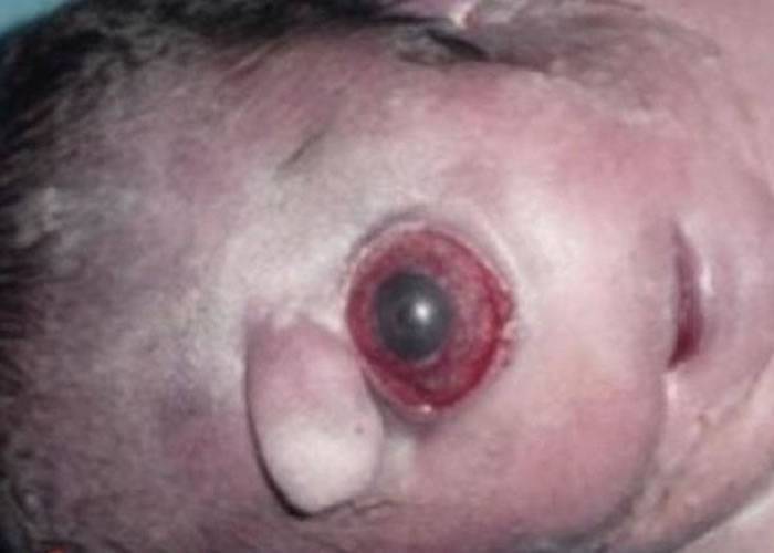 独眼畸胎的鼻子不会移动，维持在眼睛上方。