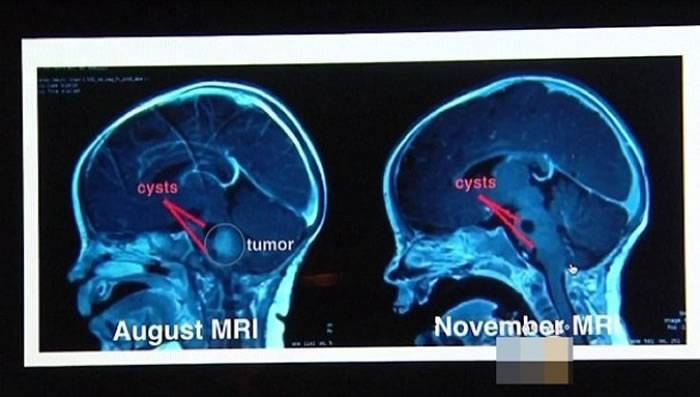 左图为8月时的脑扫描结果，右图为11月的。可见肿瘤（红圈示）大幅缩小。