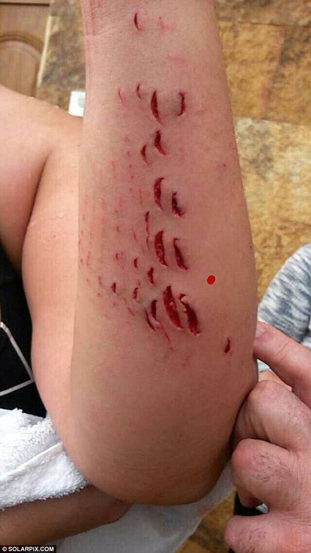 惊悚：西班牙女子遭鲨鱼啃食左手臂留下数十个凹痕