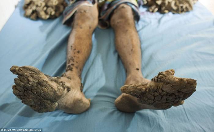 孟加拉男子AbulBajandar患罕见皮肤病手脚长出树根状的疣