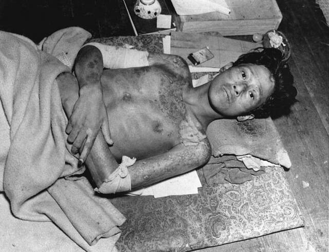 这个年轻人身上布满了长崎原子弹爆炸造成的恐怖灼伤。PhotographbyCorbis