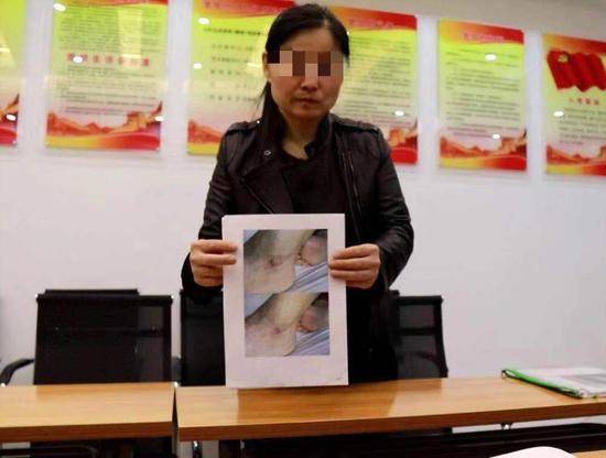 3月6日，病患家属王玉青向记者展示，父亲用药产生副作用后，足部出现的溃烂。新京报记者李永明齐超摄