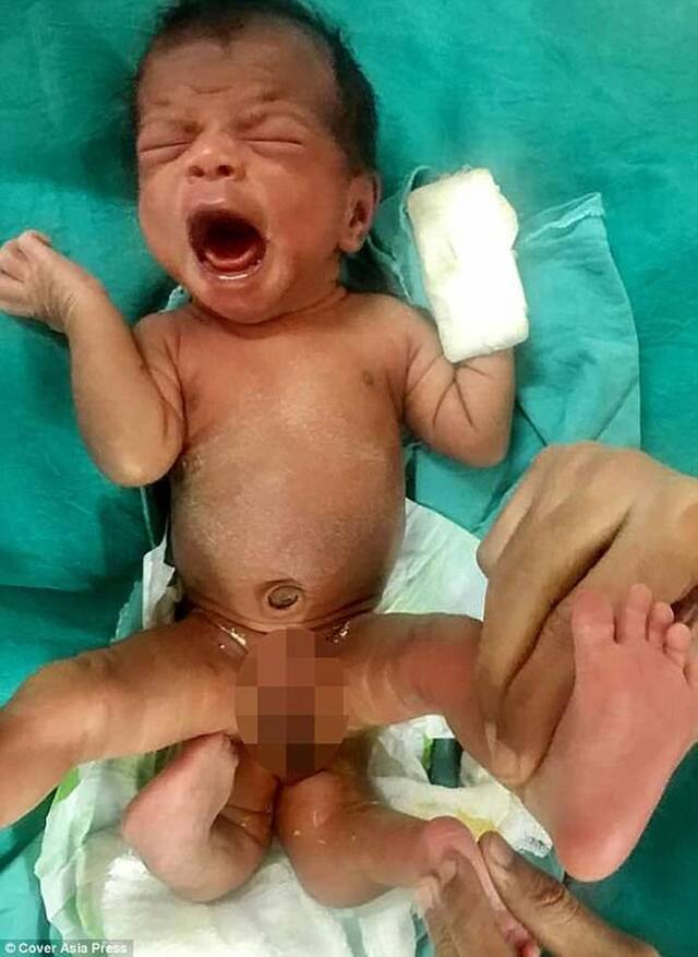 印度吉吉拉特邦5个月大女婴出生时就有4只脚被视为受诅咒的怪物