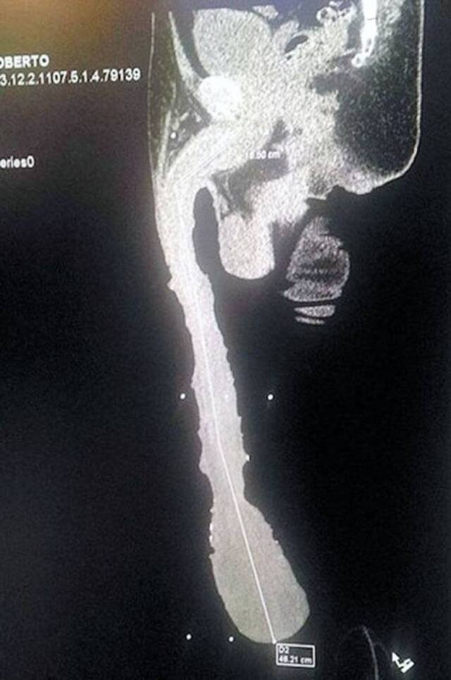 X光片证明了卡布雷拉阳具的长度