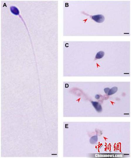 正常精子形态（A）和TTC21A基因缺陷患者的精子形态（B-E）。研究图