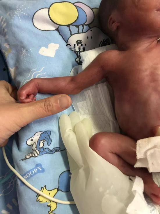 宝宝的手臂只有成人拇指粗。图