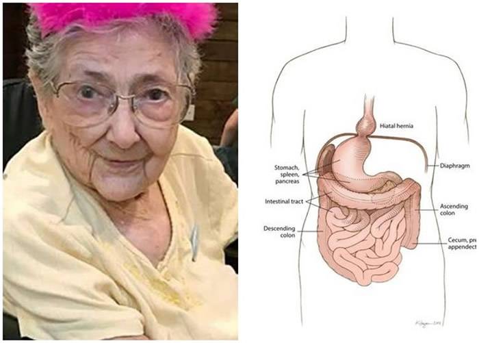 美国99岁老妇去世后捐给大学作“大体老师”发现极罕见“内脏异位合并左心症”