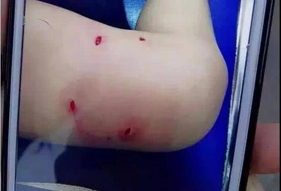 2016年武汉一名儿童右腿被咬四处伤口