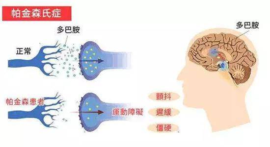 90后小伙得帕金森病 一查族谱发现与父母有关