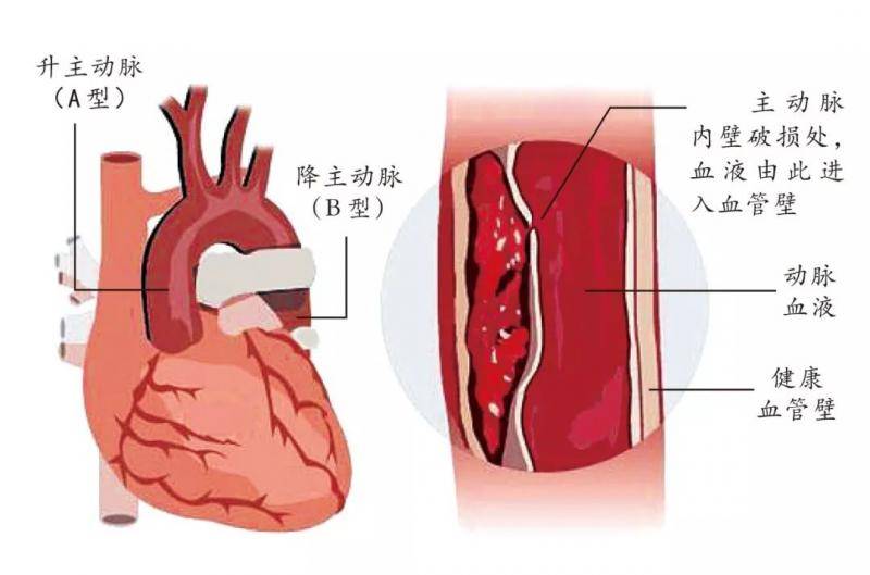 这种心脏急症救治不足1/10 青壮年男性尤其要当心