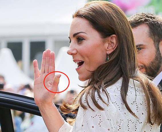 花展上的凯特王妃，右手大拇指上缠着创可贴。（图源：每日邮报）