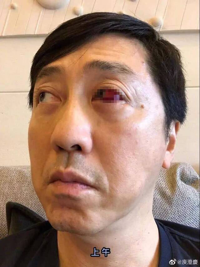 歌手庾澄庆“血眼”吓懵网友 医生却说这病很常见