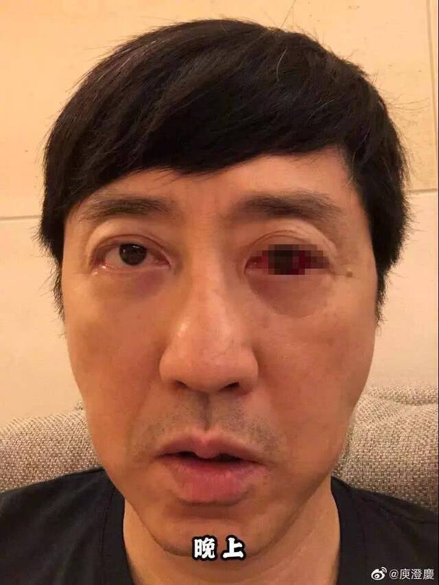 歌手庾澄庆“血眼”吓懵网友 医生却说这病很常见