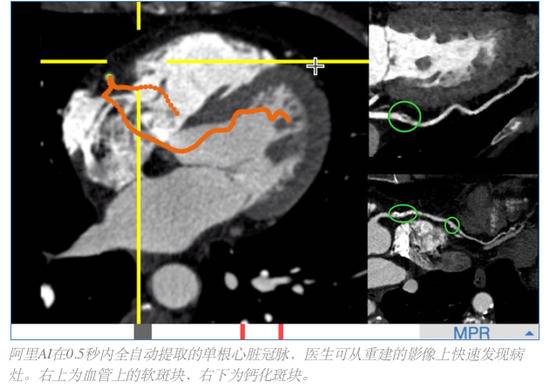直击 阿里AI新进展：攻克心血管识别 比传统提速百倍