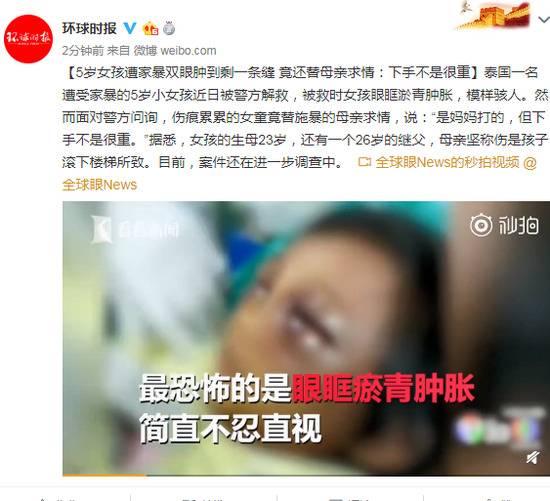 5岁女童遭家暴双眼瘀肿仍替母求情：下手不是很重