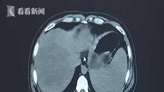 血液里居然有“牛奶”？准新郎腹痛拒治疗险丧命