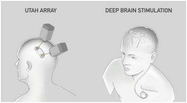 Neuralink欲在2020年投入人体临床试验图片来源：Neuralink