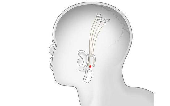 马斯克发布的脑机接口系统将使用大量细线来收集大脑信号以跟踪脑电波。这些细线将连接到一个脑波发射器上，该发射器可像助听器一样戴在耳后。图/发布会展示视频截图