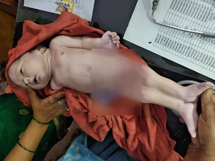 印度北方邦拉基姆普尔凯里县诞生一名患有美人鱼综合症的婴儿