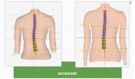 女孩一跑步髋关节就脱位 这毛病50人中就有1人有