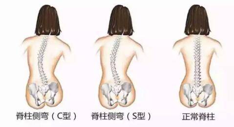 女孩一跑步髋关节就脱位 这毛病50人中就有1人有