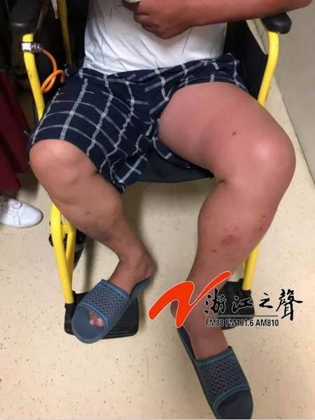 男子左腿突然发“胖” 医生:再晚来可能没命(图)