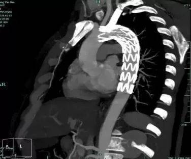 行主动脉支架植入
