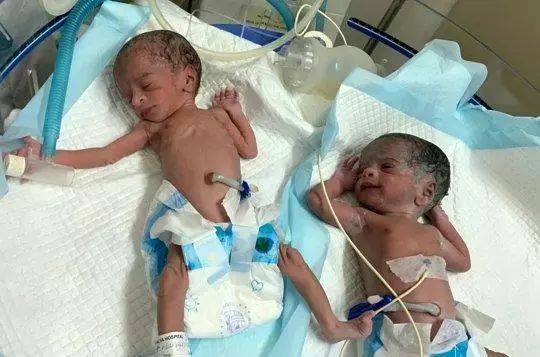 ∆艾拉马蒂·曼加亚玛的一对双胞胎女儿，每个都有4磅重（图据雅虎新闻）