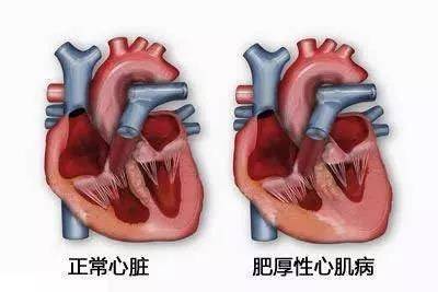 男子晕倒后查出得了心脏病 医生：跑步跑出来的