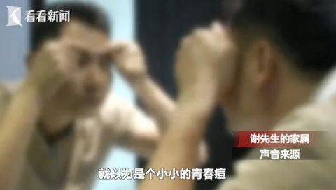 51岁男子随手挤了颗痘 发展成了恶性肿瘤(图)