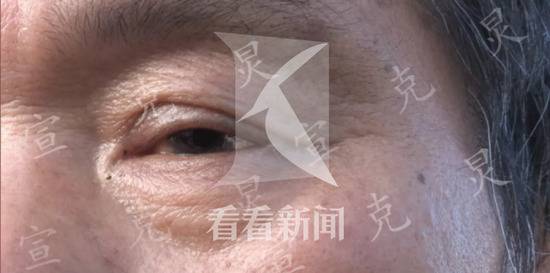 男子自制弹弓打狗 却导致邻居一只眼睛失明