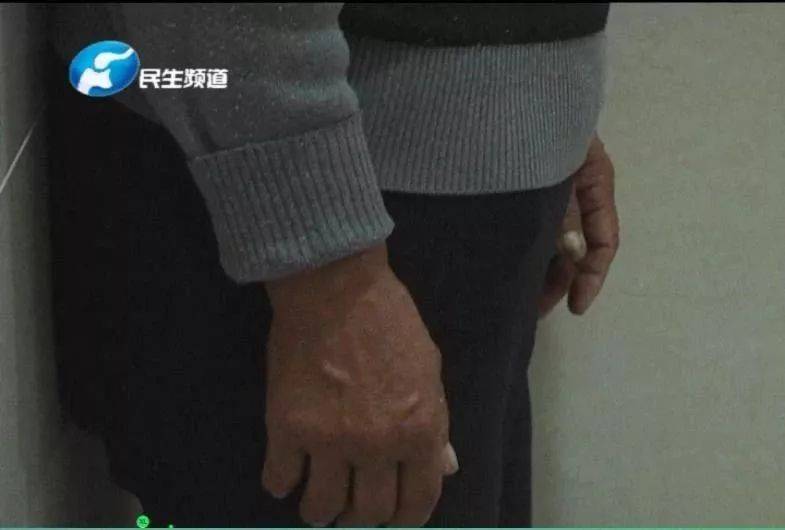 河南13个月大孩子被咬掉半边脸 狗主人愿筹钱看病