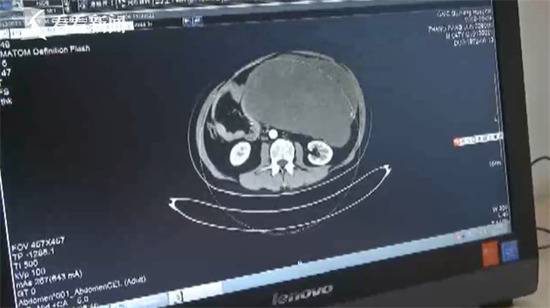 男子腹痛难忍 这颗