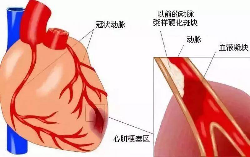 知名演员昨天突然去世！这病几分钟就可夺命！东莞人千万警惕！