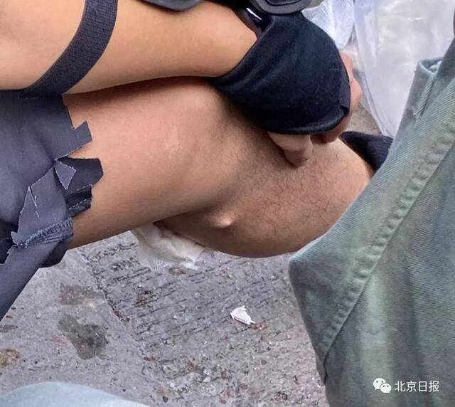 遭暴徒弓箭射腿钢珠击脸 香港警协提出个强烈呼吁