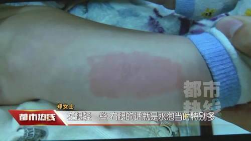 七个月大婴儿患病后做推拿艾灸 腿部被严重烫伤