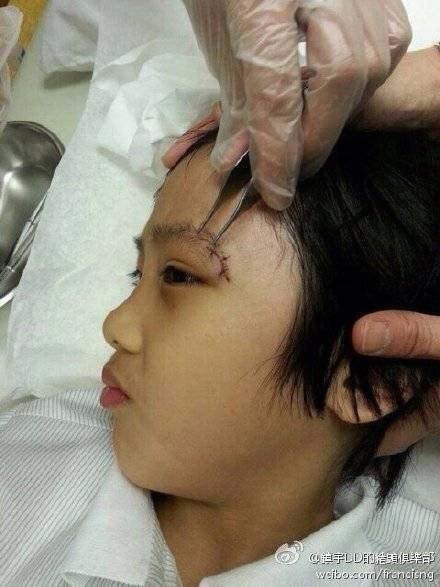 2014年，《爸爸去哪儿》第二季录制过程中，吴镇宇的儿子费曼意外伤到眼角。图/吴镇宇微博
