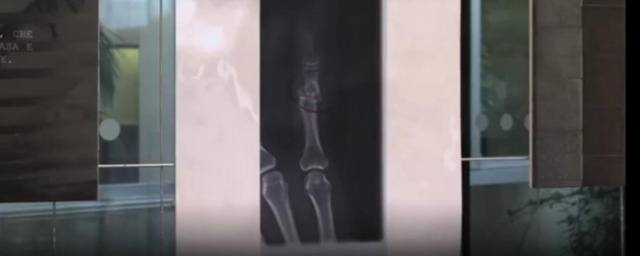 意大利米兰一家医院展出的遭受家暴女性的X光片