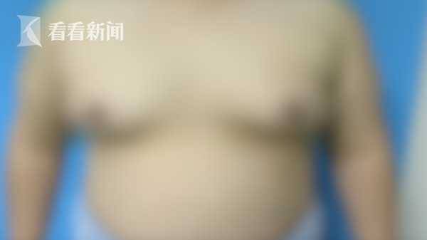 男子胸部发育成C罩杯 手术