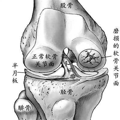 “老寒腿”是不穿秋裤冻出来的？想多了