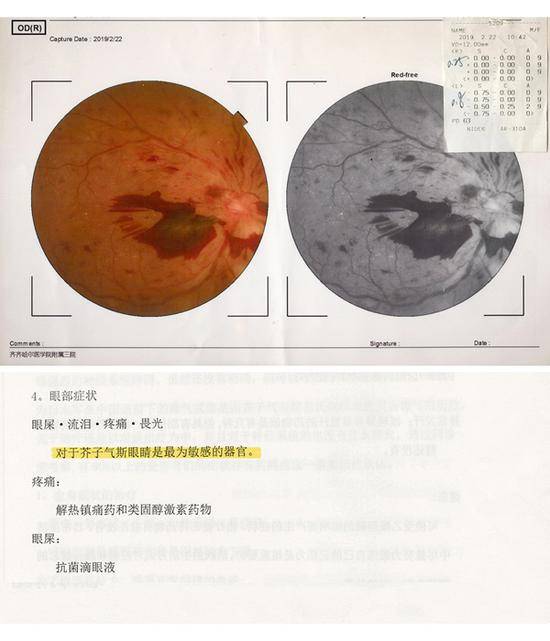 一位“八四”毒气事件受害者的眼球诊断图（上）；日本医师矶野理有关芥子气治疗的学科论文部分截图（下）。