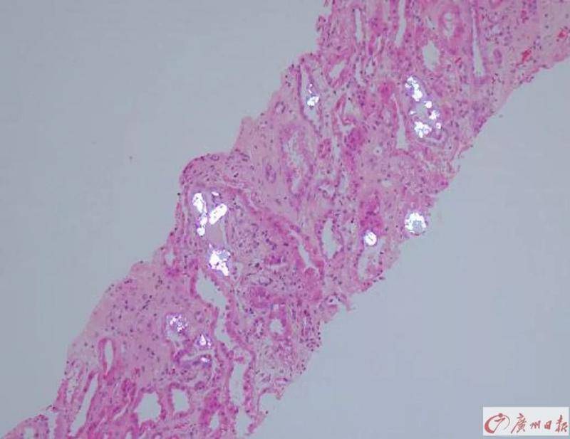 肾小管造影显示存在大量结晶沉淀物。（银白色部分）