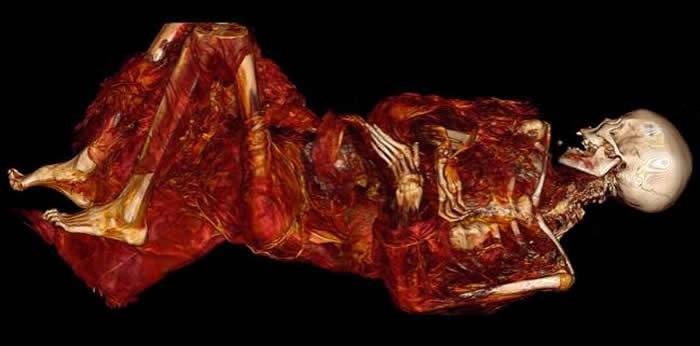 500年木乃伊研究发现格陵兰岛因纽特人以富含Omega-3脂肪酸的鱼类为主食依旧有动脉硬化问题