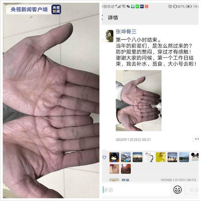 △发热门诊医生张坤，八小时工作完，双手已经被汗水泡皱