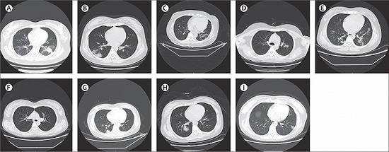 9名确诊新冠肺炎孕妇的胸部CT扫描片。来源：《柳叶刀》