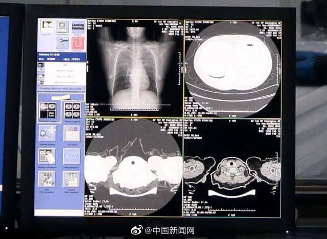 上百家医院将用AI诊断疑似肺炎病例