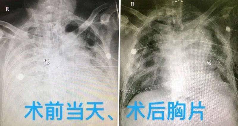 新冠肺炎病危患者肺移植手术成功，切除肺正病理解剖