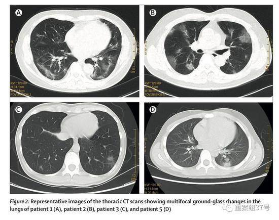 ▲有武汉旅行史的返深圳家庭中，多名家庭成员呈现肺部多发磨玻璃样改变，其中10岁的患者为无症状感染者。论文截图